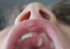 Criança com dente no céu da boca: saiba mais sobre causas e tratamento; céu da boca de criança mostra o mesiodente