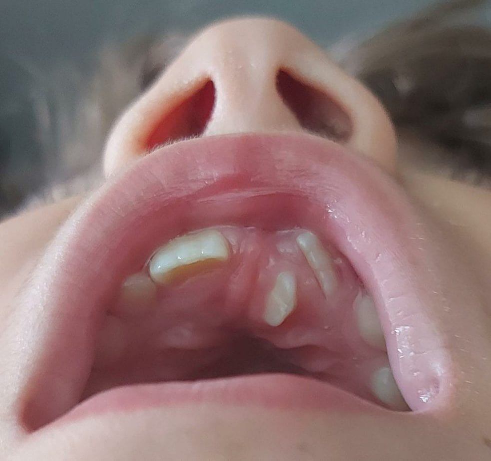 Criança com dente no céu da boca: saiba mais sobre causas e tratamento; céu da boca de criança mostra o mesiodente