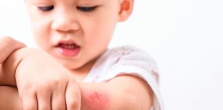 Estresse da pandemia pode agravar alergias nas crianças; menino pequeno coça cotovelo