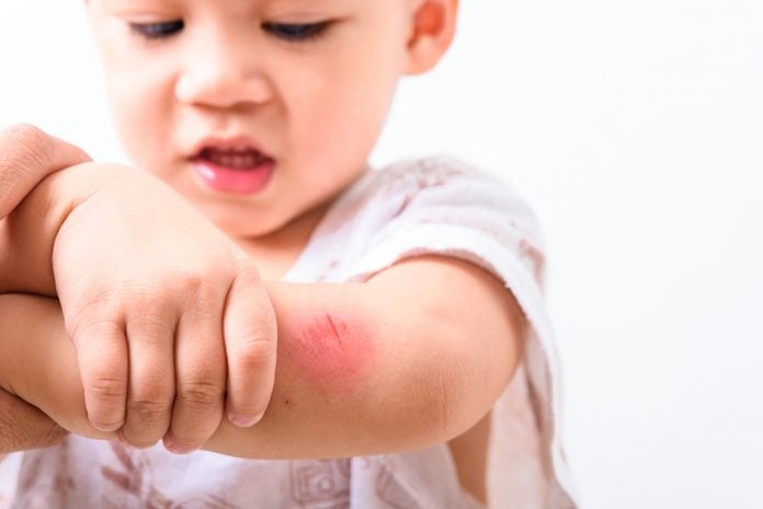 Estresse da pandemia pode agravar alergias nas crianças; menino pequeno coça cotovelo