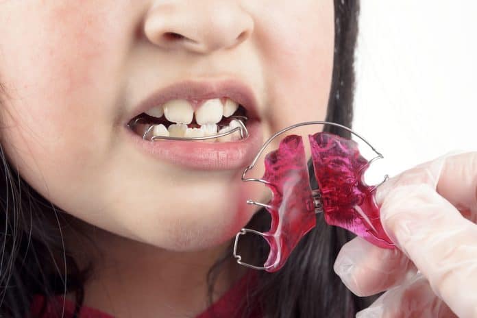 6 dúvidas comuns sobre o uso de aparelhos ortodônticos em crianças; imagem mostra boca de menina e aparelho móvel rosa em acrílico