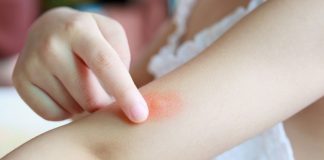 O verão e as picadas de inseto: saiba quando a criança tem alergia; criança coçando picada vermelha e inchada no braço