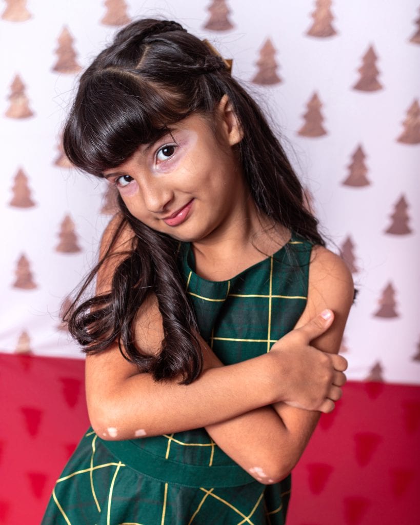 Bianca Ribeiro, 6 anos, foi diagnosticada com vitiligo na infância