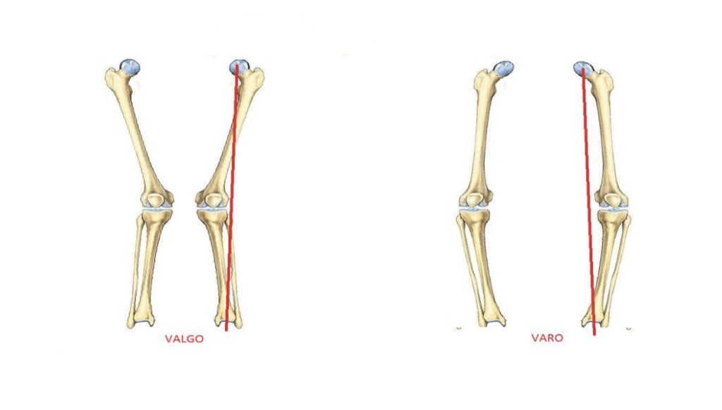 Ilustração mostrando a estrutura óssea do joelho valgo (pernas em X) e o joelho varo (pernas arqueadas)