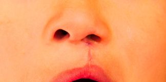 Nariz e boca de uma criança, que passou pela cirurgia de fissura labial