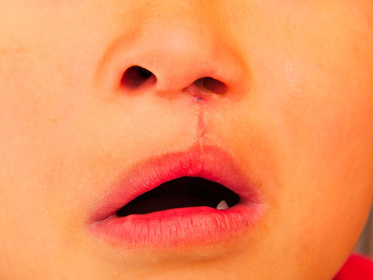 Fissura labial e fenda palatina: saiba mais sobre essas malformações congênitas