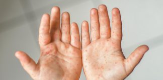 Mãos com a doença mão-pé-boca