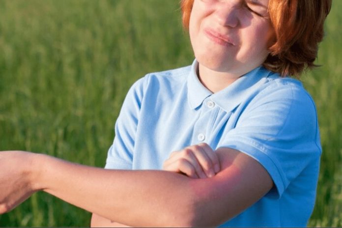Alergias de verão: saiba como prevenir e tratar; criança coçando o braço