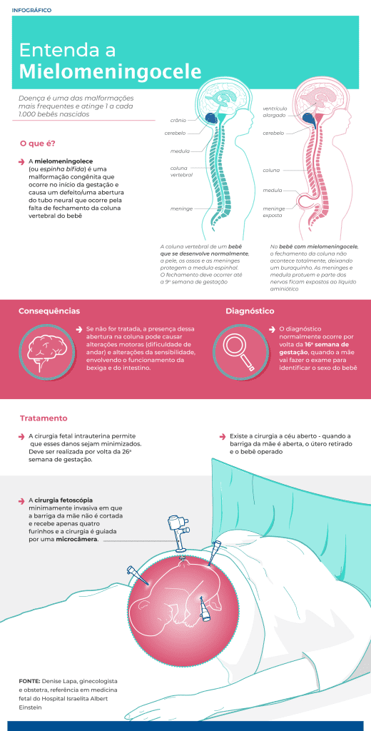 Infográfico Mielomeningocele