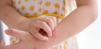 Menina coçando lesão vermelha; 4 sinais de que seu filho está tendo uma crise de alergia alimentar