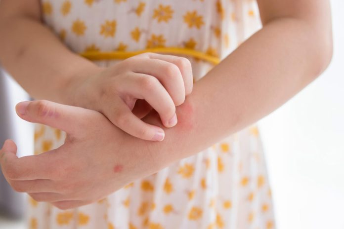 Menina coçando lesão vermelha; 4 sinais de que seu filho está tendo uma crise de alergia alimentar