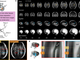 Imagens do cérebro de bebês participantes de estudo publicado na Nature sobre Atlas digital da evolução ideal do cérebro na gestação
