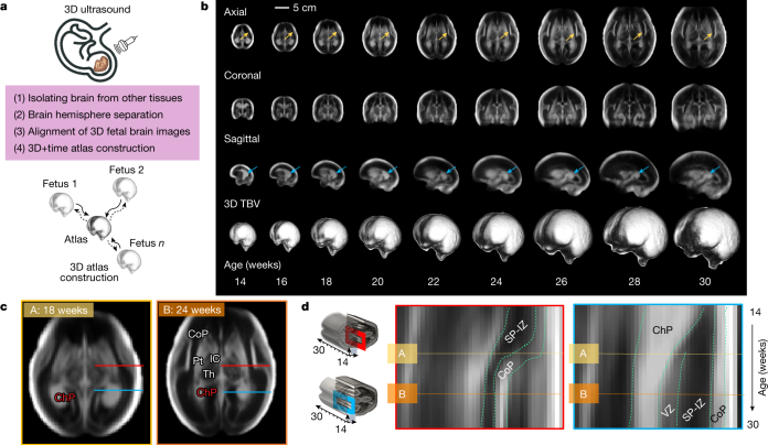 Imagens do cérebro de bebês participantes de estudo publicado na Nature sobre Atlas digital da evolução ideal do cérebro na gestação