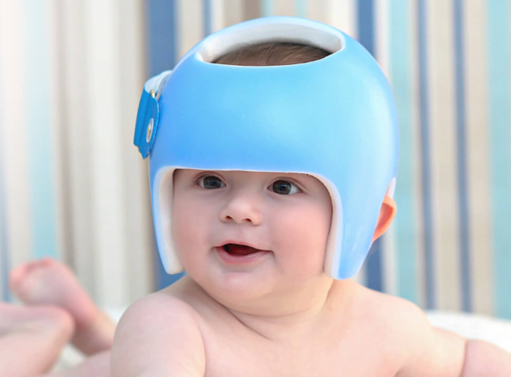 Assimetria craniana em bebês: a importância do uso de capacete 